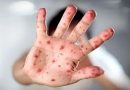Estudio detecta diferentes síntomas en la viruela del mono / UK monkeypox symptoms different to prior outbreaks: study